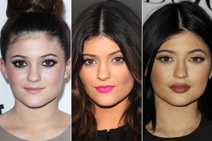 More And More People Are Getting Lip Injections, Thanks To Kylie Jenner More And More People Are Getting Lip Injections, Thanks To Kylie Jenner